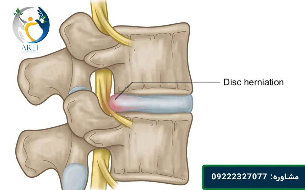 تخریب دیسک بین مهره ای
